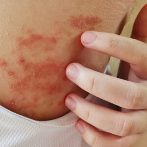 3 effective ways to manage atopic dermatitis